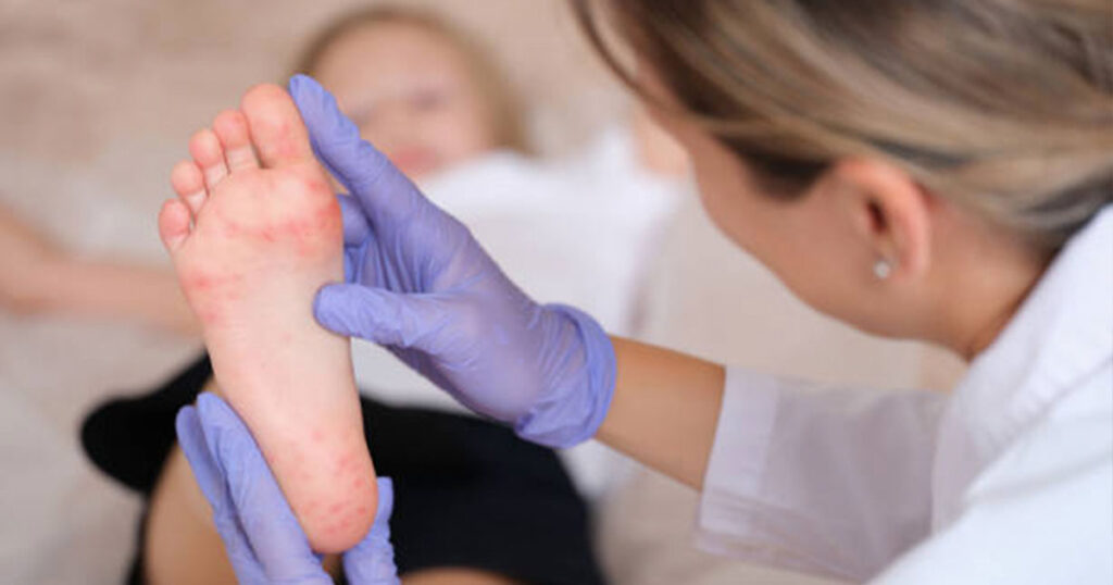 Pide la Secretaría de Salud reforzar las medidas preventivas ante casos de Coxsackie